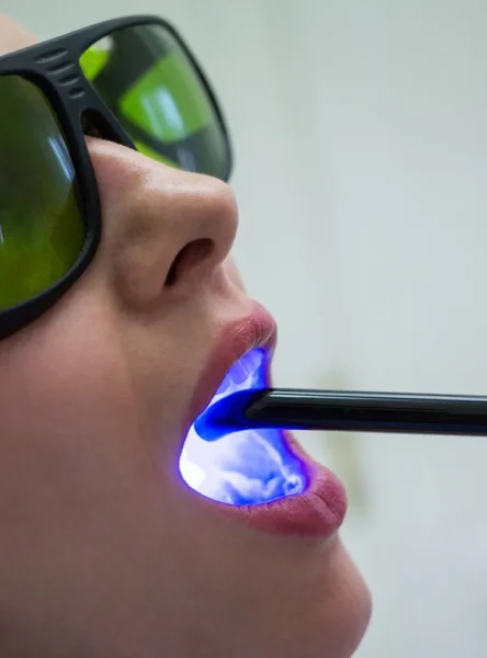 lazer ile beyazlatma