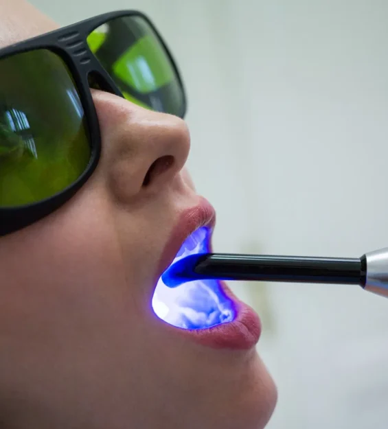 lazer ile beyazlatma